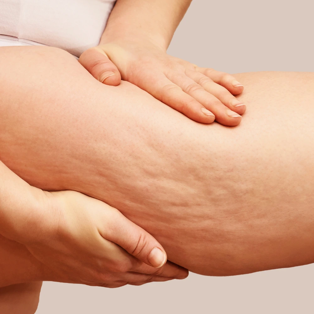 Cellulite consultation at LAVAĒ Sculpt Singapore
