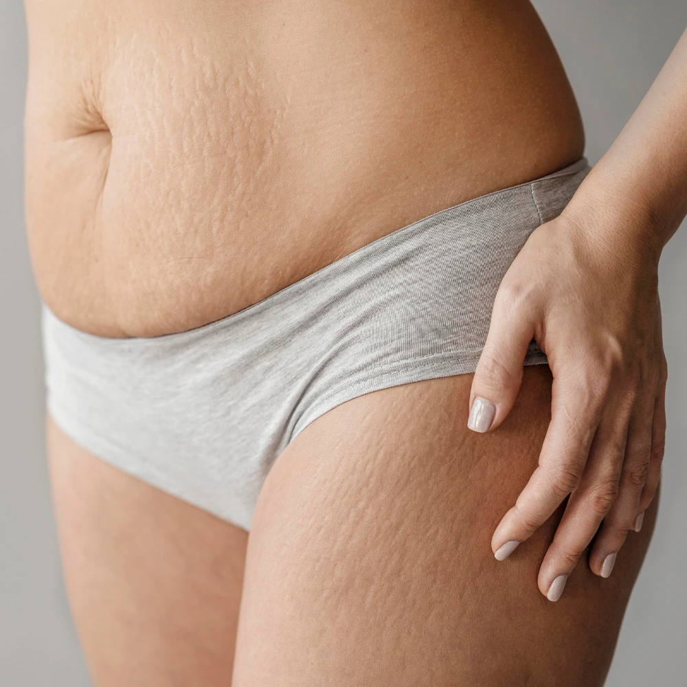 Stretch Marks & Scars consultation at LAVAĒ Sculpt Singapore