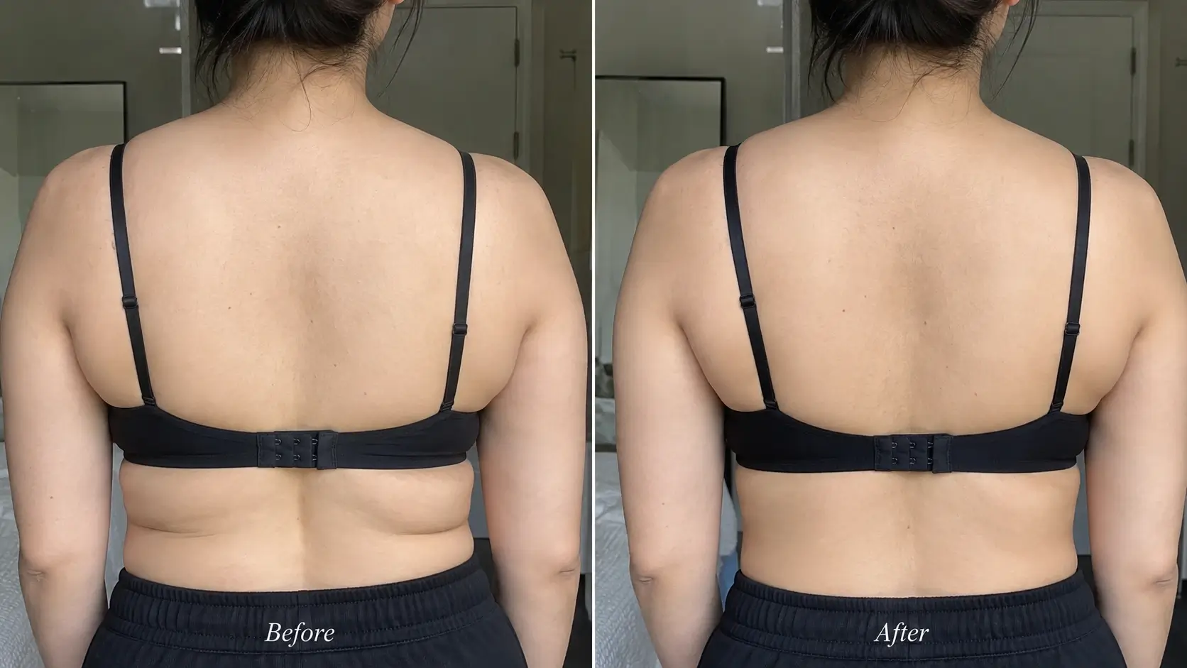 before and after view of bra-line and upper-back contour