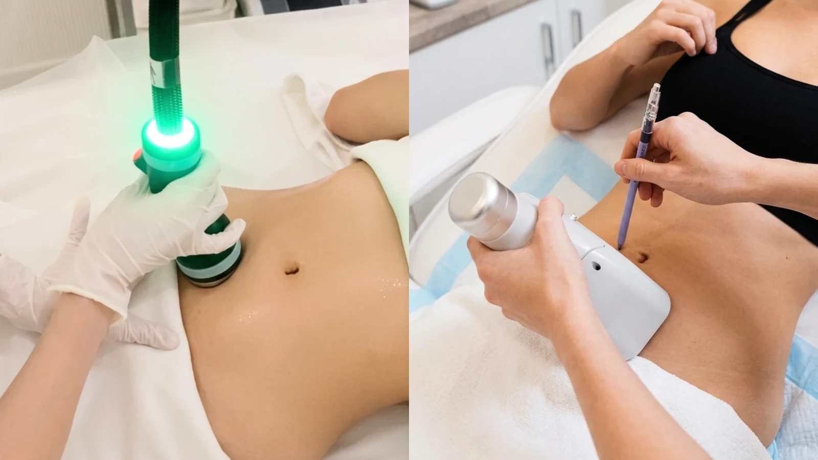 Onda Pro and fat freezing comparison for non-invasive body contouring in Singapore