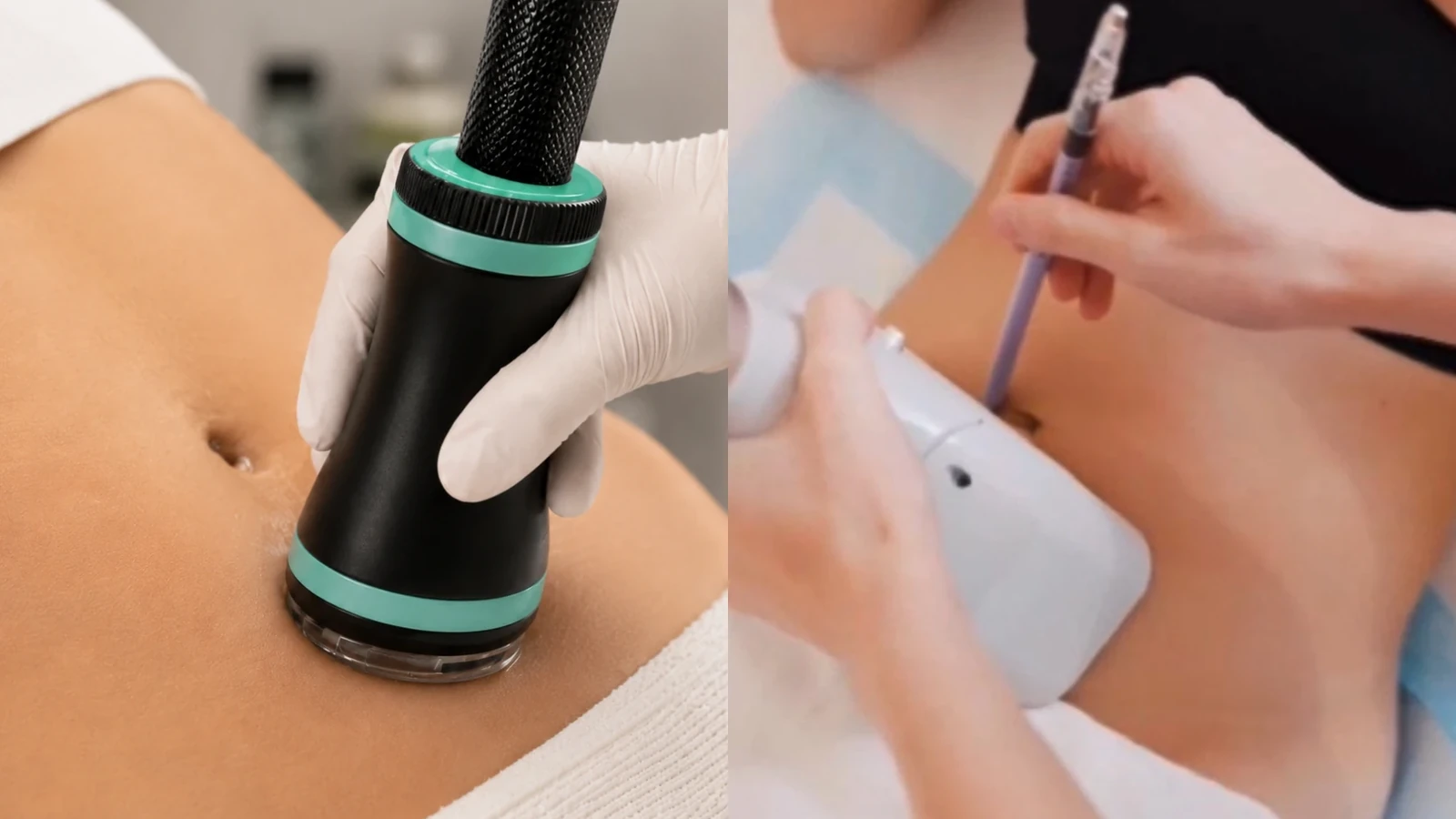 Onda Pro and fat freezing treatment comparison for body contouring and localised fat reduction in Singapore