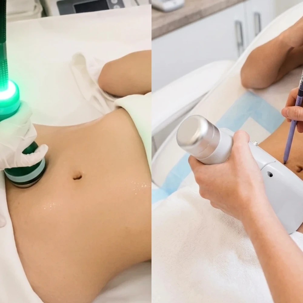 Onda Pro vs Fat Freezing