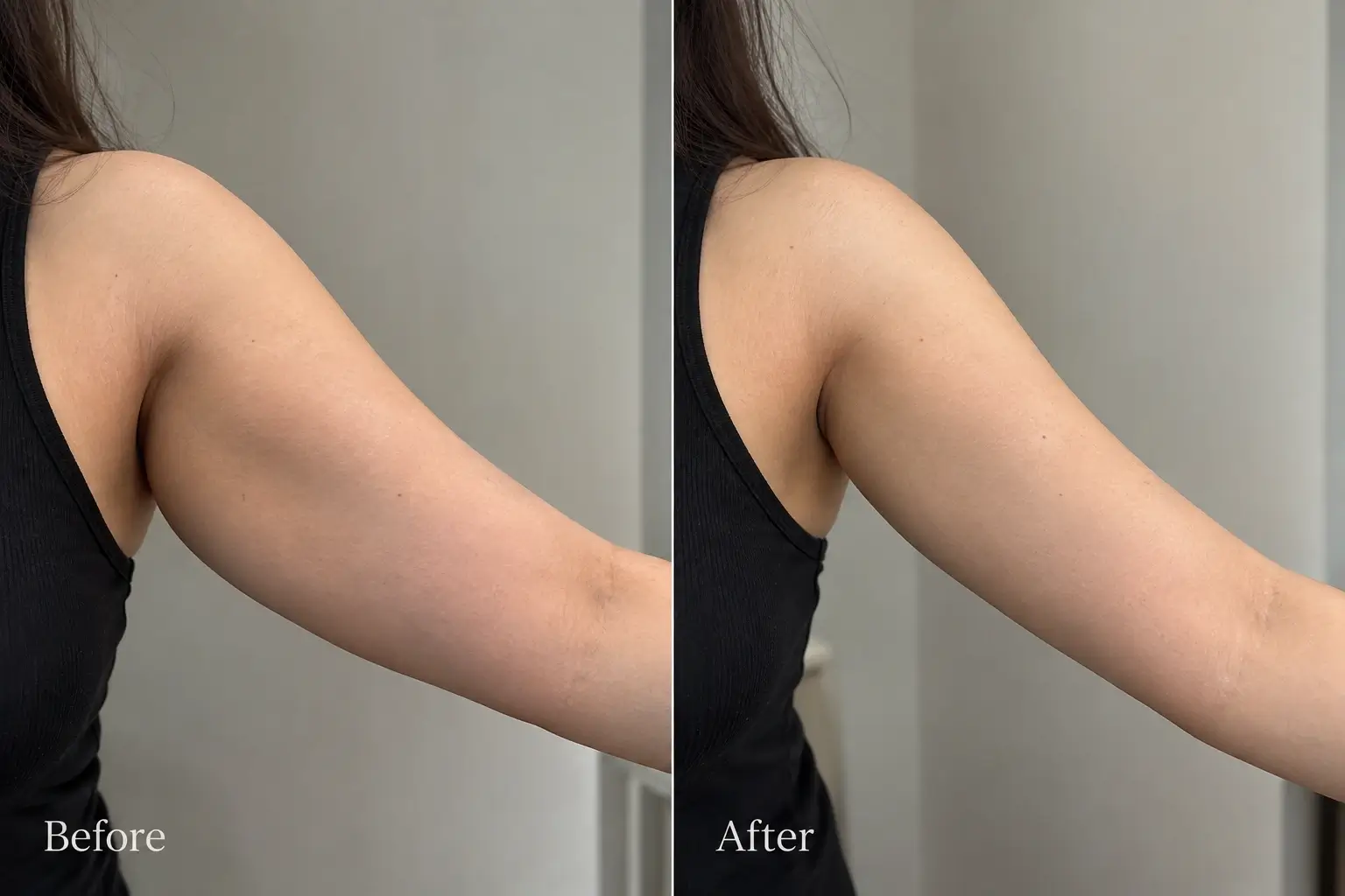Illustrative before and after view of upper arm contour
