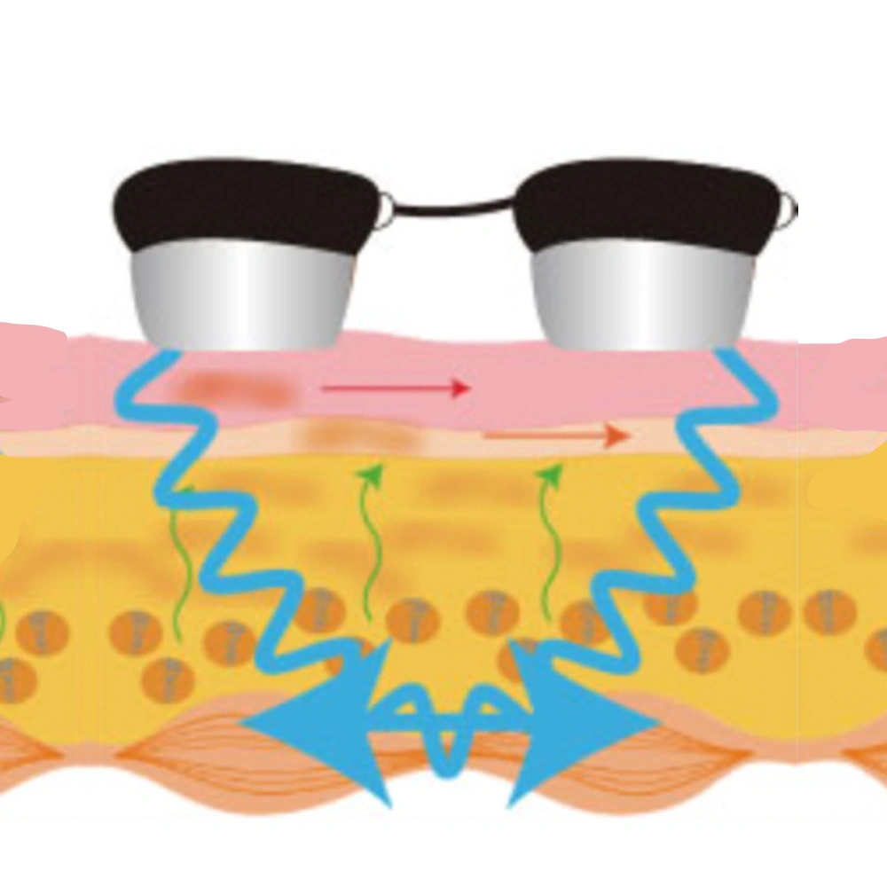 1.5 MHz Ultrasound treatment area or benefit for Japan Cavi 3S Pro