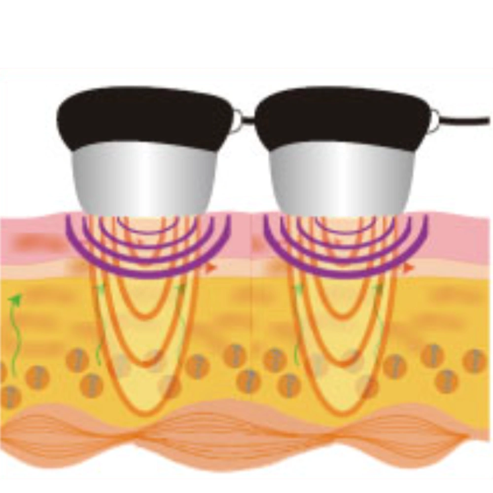 38 kHz Cavitation treatment area or benefit for Japan Cavi 3S Pro