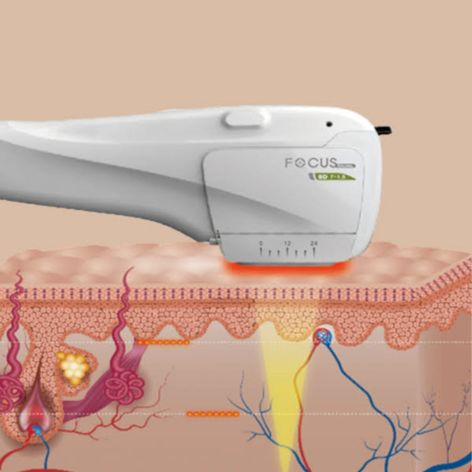 Focused Depths treatment area or benefit for HIFU Body Treatment