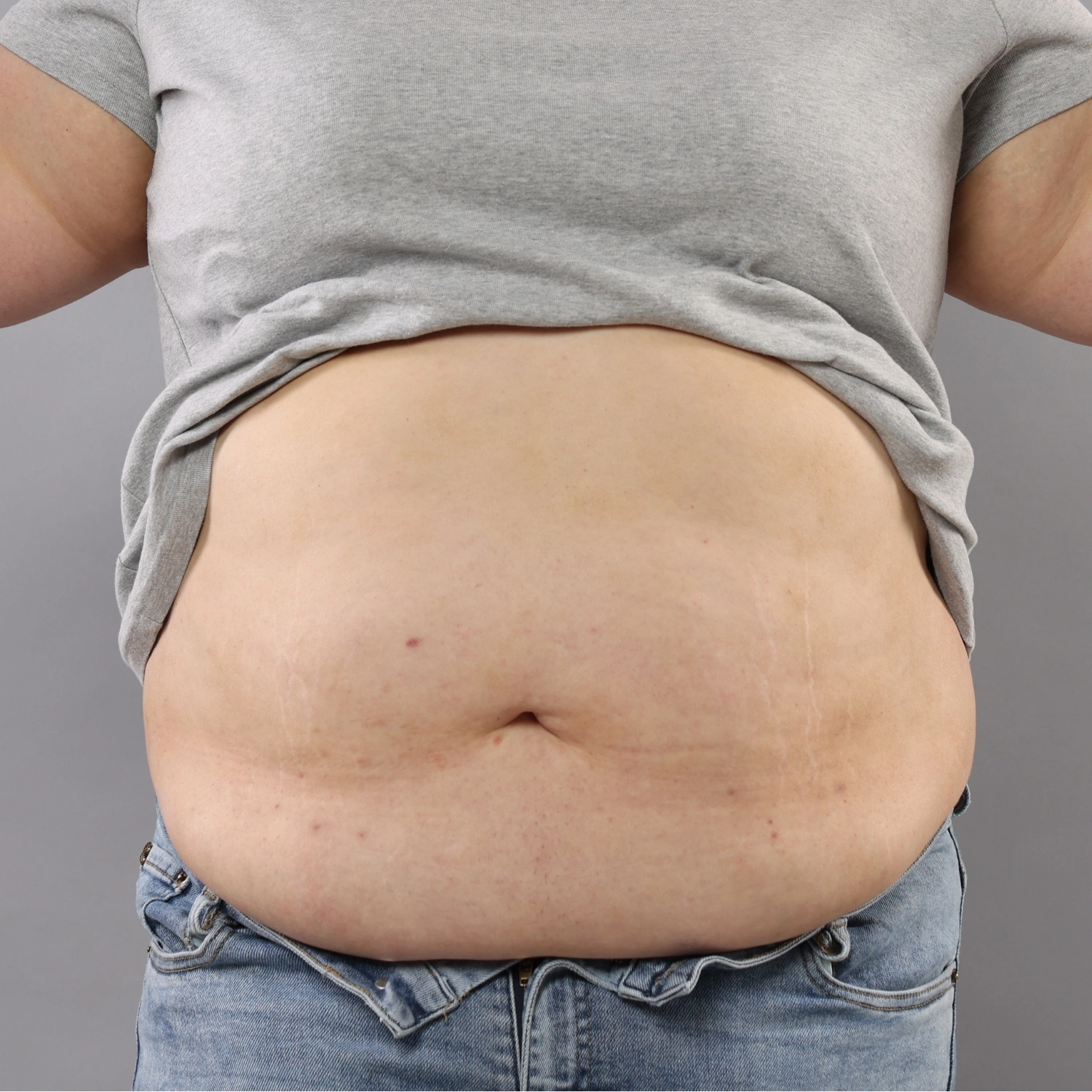 Localised fat treatment icon