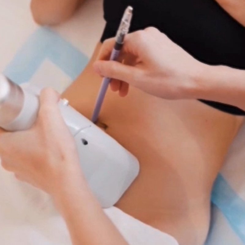 Experience information for Cryo 360 Fat Freeze at LAVAĒ Sculpt