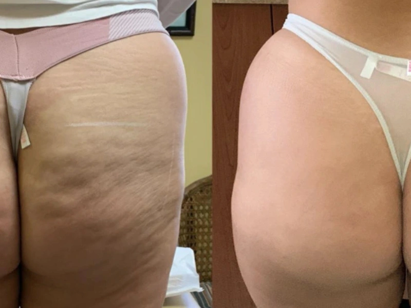 CurvX Sculpt before and after result