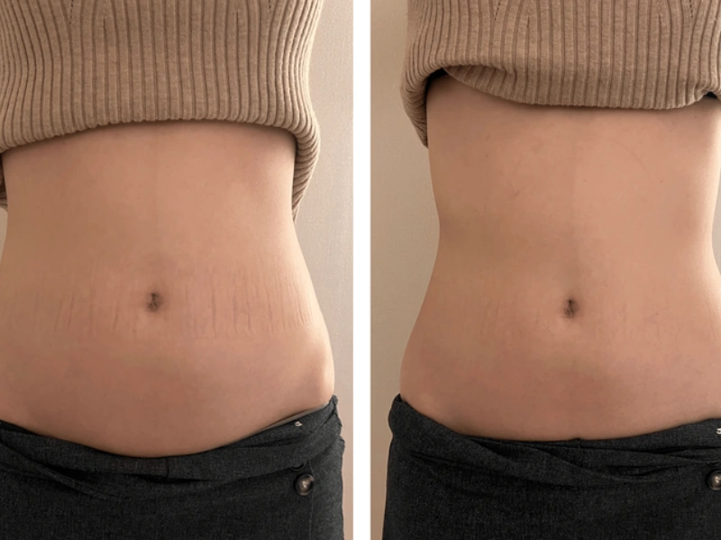 Emshape Body Sculpture before and after result