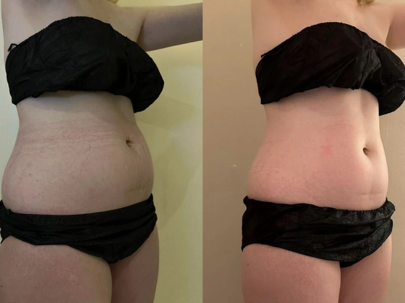 Emshape Body Sculpture before and after result