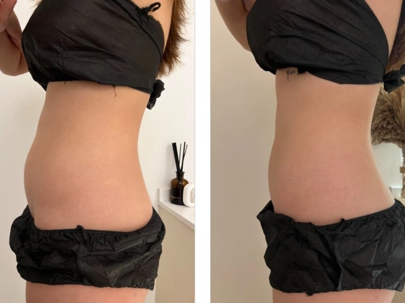 Emshape Body Sculpture before and after result