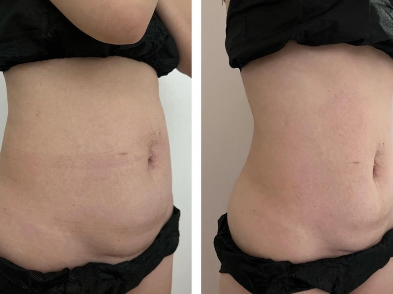 Emshape Body Sculpture before and after result