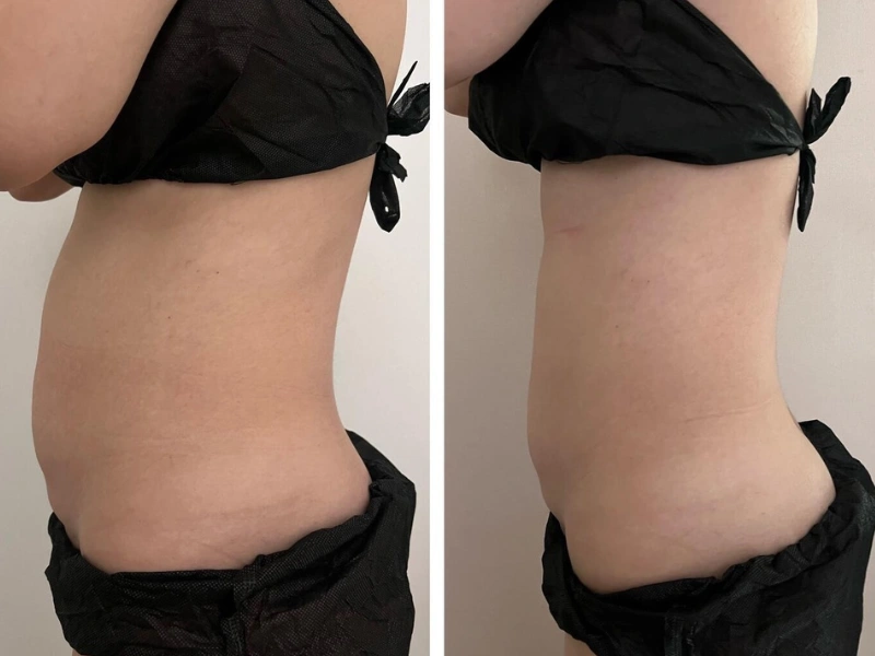 Emshape Body Sculpture before and after result