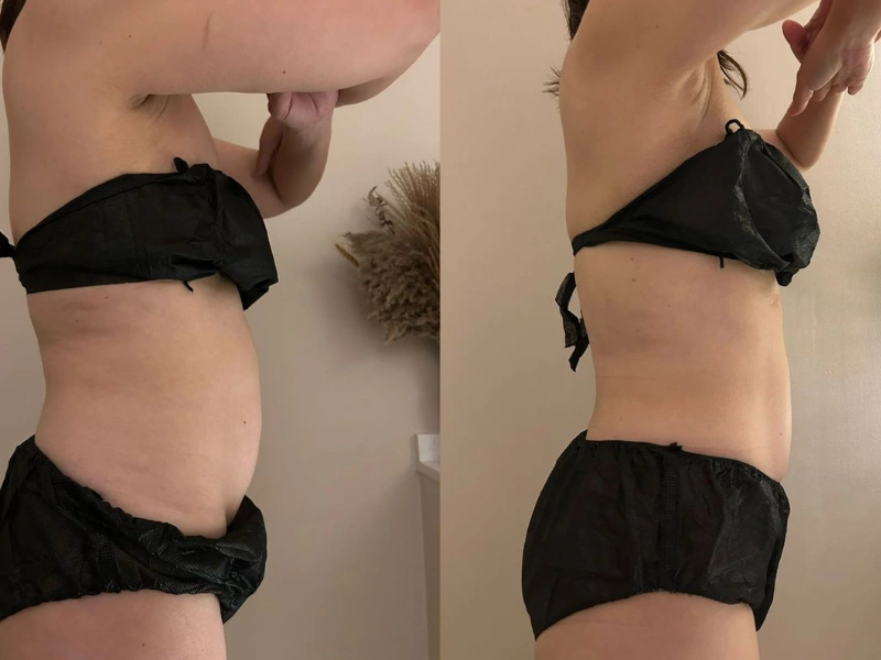 Emshape Body Sculpture before and after result