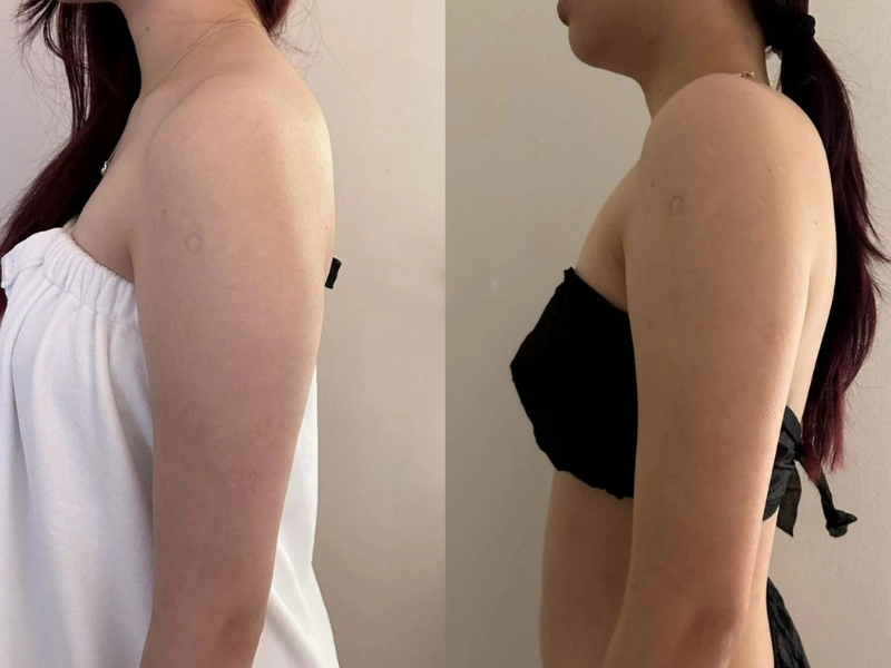 Emshape Body Sculpture before and after result