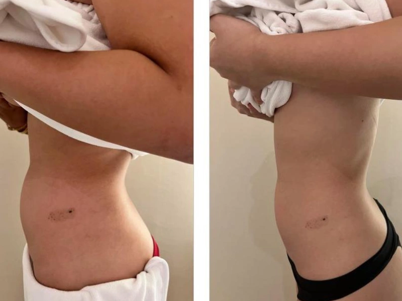 Emshape Body Sculpture before and after result