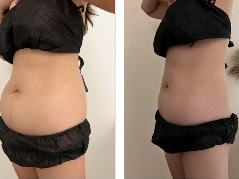 Emshape Body Sculpture before and after result