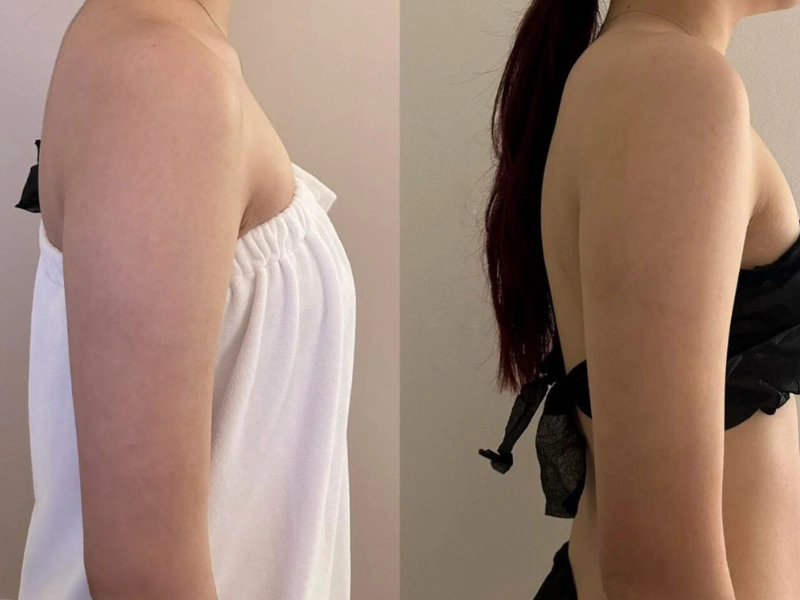 Emshape Body Sculpture before and after result