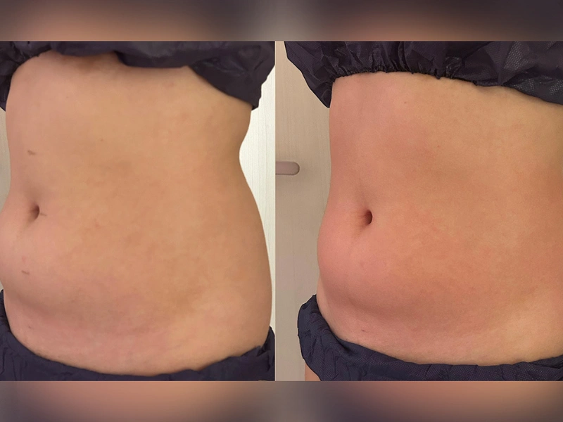 INDIBA Body Contouring before and after abdomen contouring result