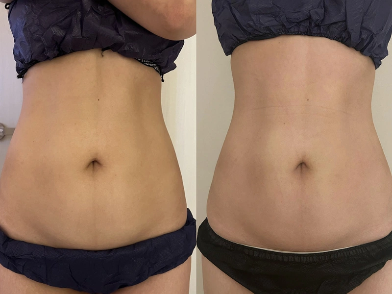 INDIBA Body Contouring before and after waist and flank treatment result