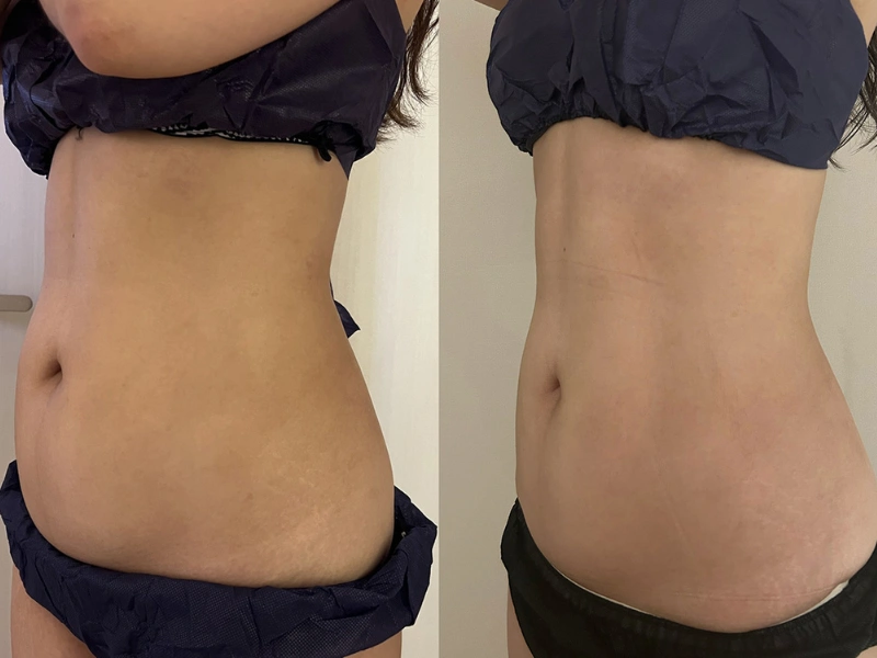 INDIBA Body Contouring before and after skin firming and body contour result