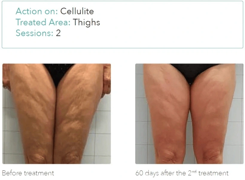 Onda Pro before and after cellulite reduction on thighs