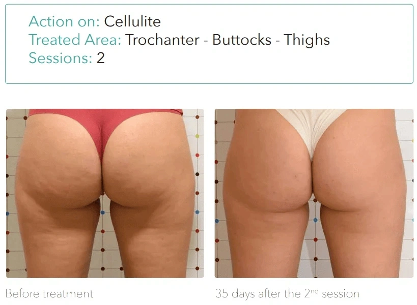 Onda Pro before and after cellulite reduction on buttocks and thighs