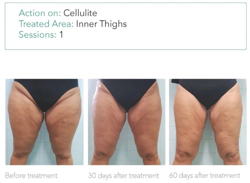 Onda Pro before and after inner thigh cellulite treatment