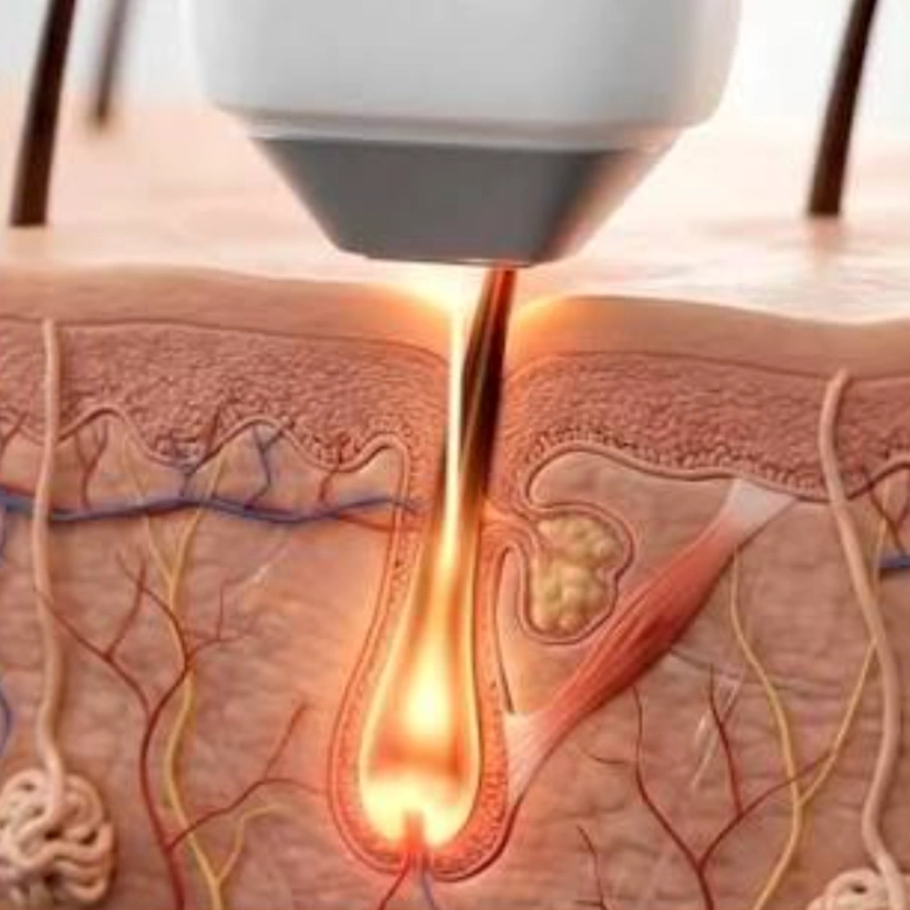 In-Motion Delivery treatment area or benefit for SHR Hair Removal